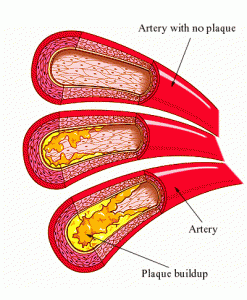 atherosclerosisplaque